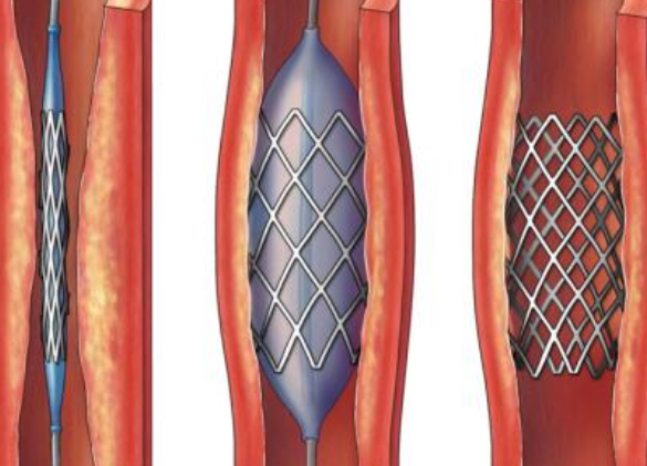 好消息！700元冠脈支架來了帶量采購結(jié)果在甘肅省正式落地執(zhí)行